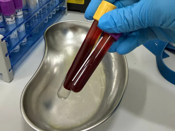 Two blood sample tubes held above a metal tray.